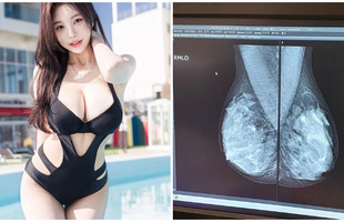 Bị nghi ngờ hack cheat vòng một, cô nàng hot girl quyết tâm đi chụp X-quang, chứng minh ngực của mình tự nhiên 100%